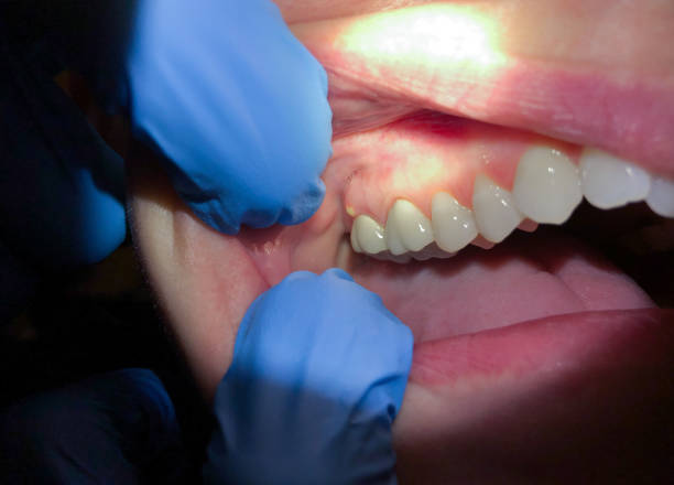 Best Chipped Tooth Repair Near Me  in Morganton, NC